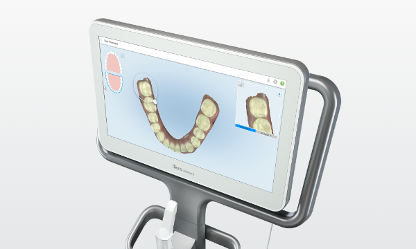 精密検査とお口の型取りiTero写真