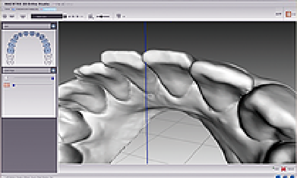デジタル解析と治療計画の作成写真